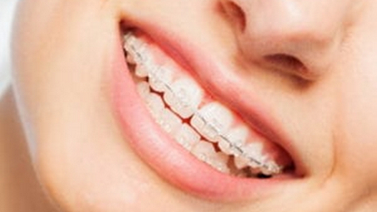 Is It Possible to Straighten Teeth Without Wire Braces?